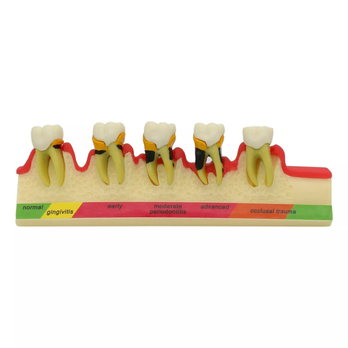Dental Pathological Typodont Teeth Model Periodontics/Implant/Endodontic Caries