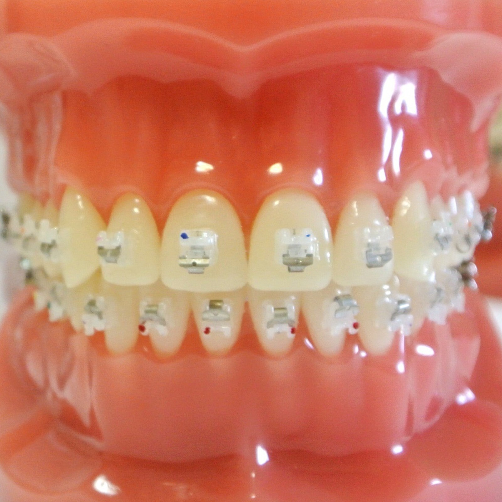 Orthodontic Self Ligating Brackets Metal Ceramic Roth MBT Damon Q Empower Clear