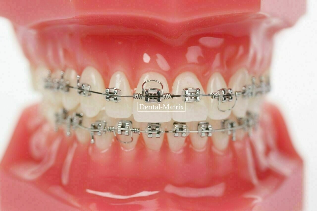 Dental Orthodontic Torquing Torque Spring Rectangular Wire Single Anterior Teeth