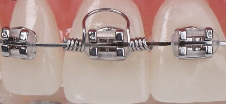 (10 pieces) Orthodontic TORQUING SPRING .019″ x .025″ SMALL / USA seller