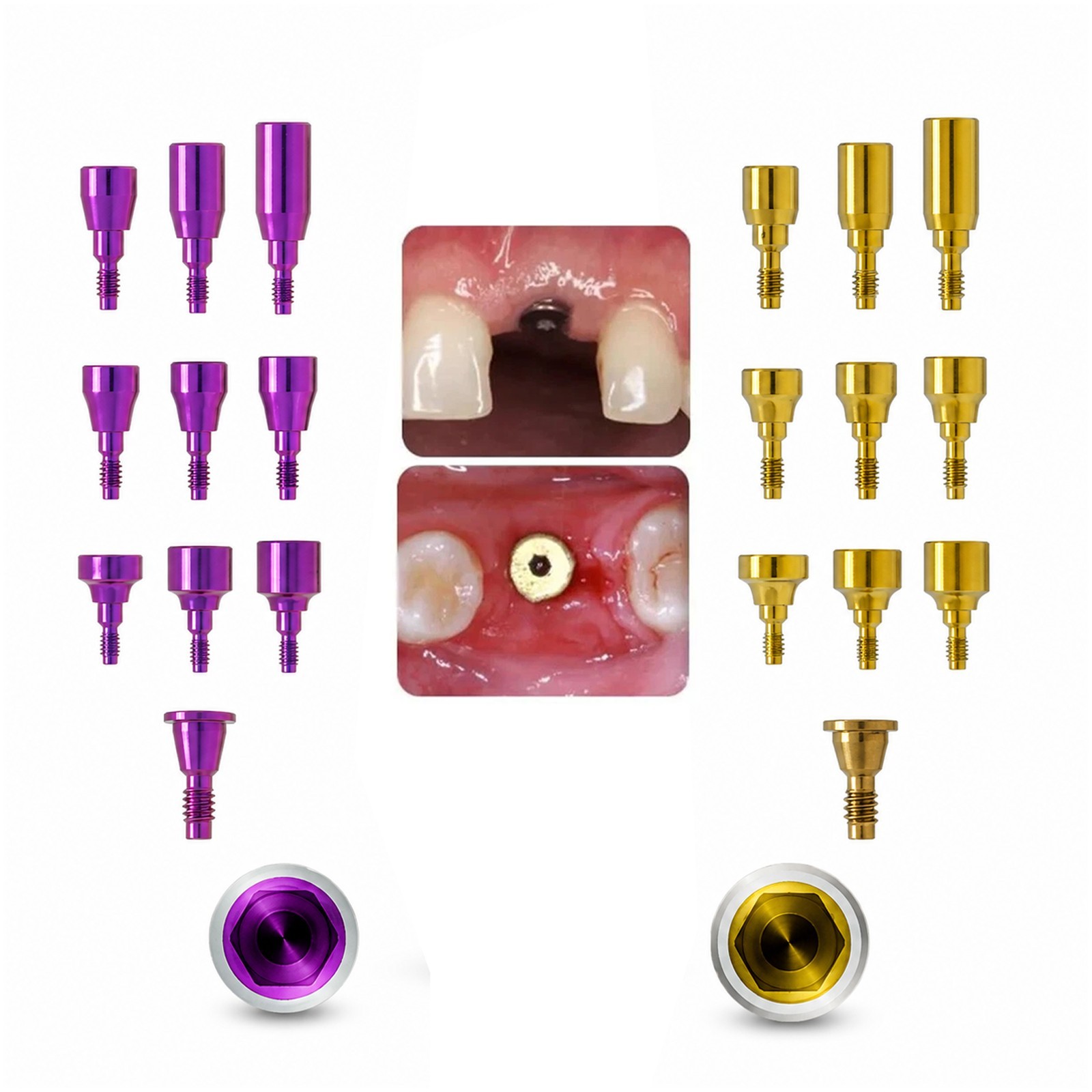 US Nobel Active Nobel Parallel CC Healing Abutment Compatible Conical Connection