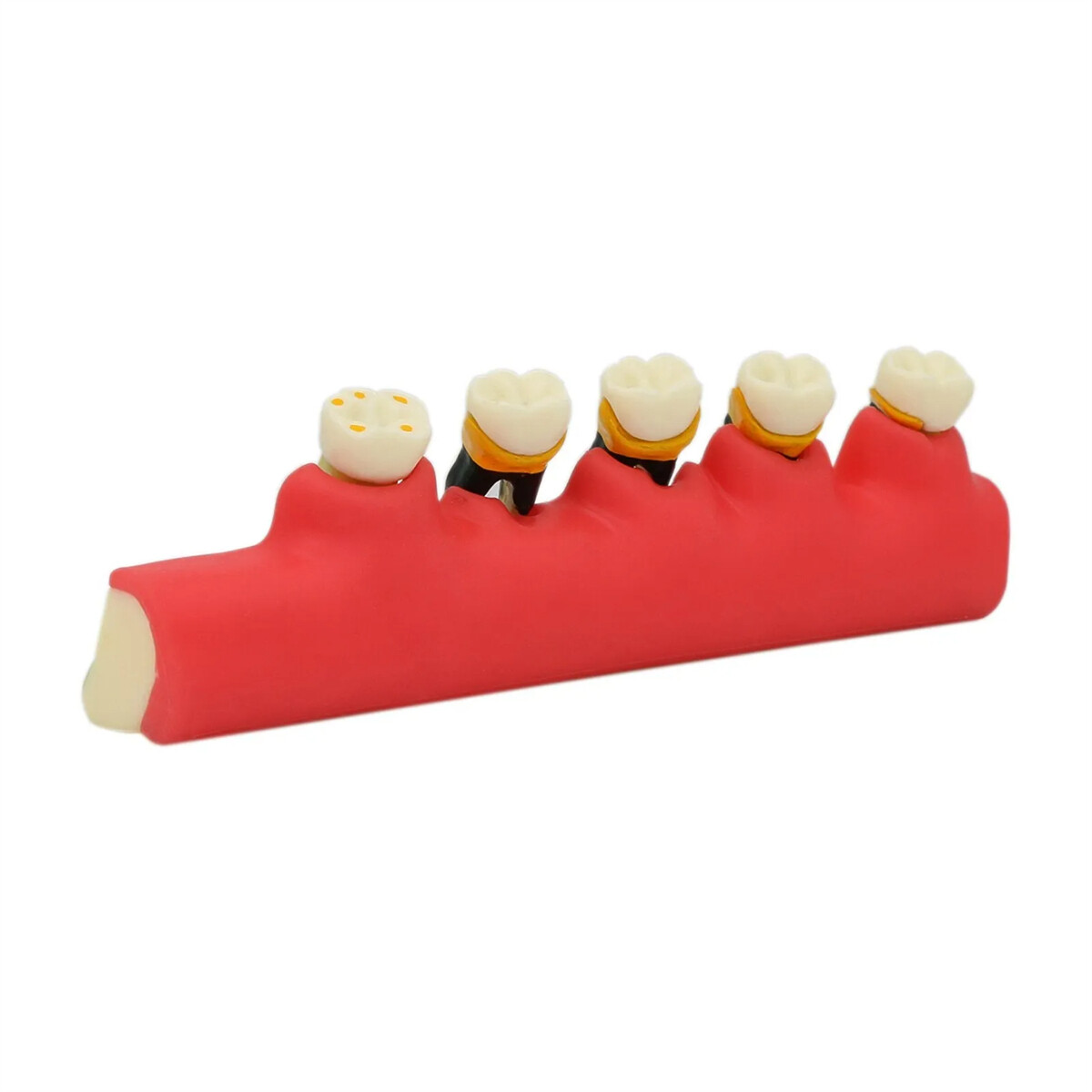 Dental Pathological Typodont Teeth Model Periodontics/Implant/Endodontic Caries