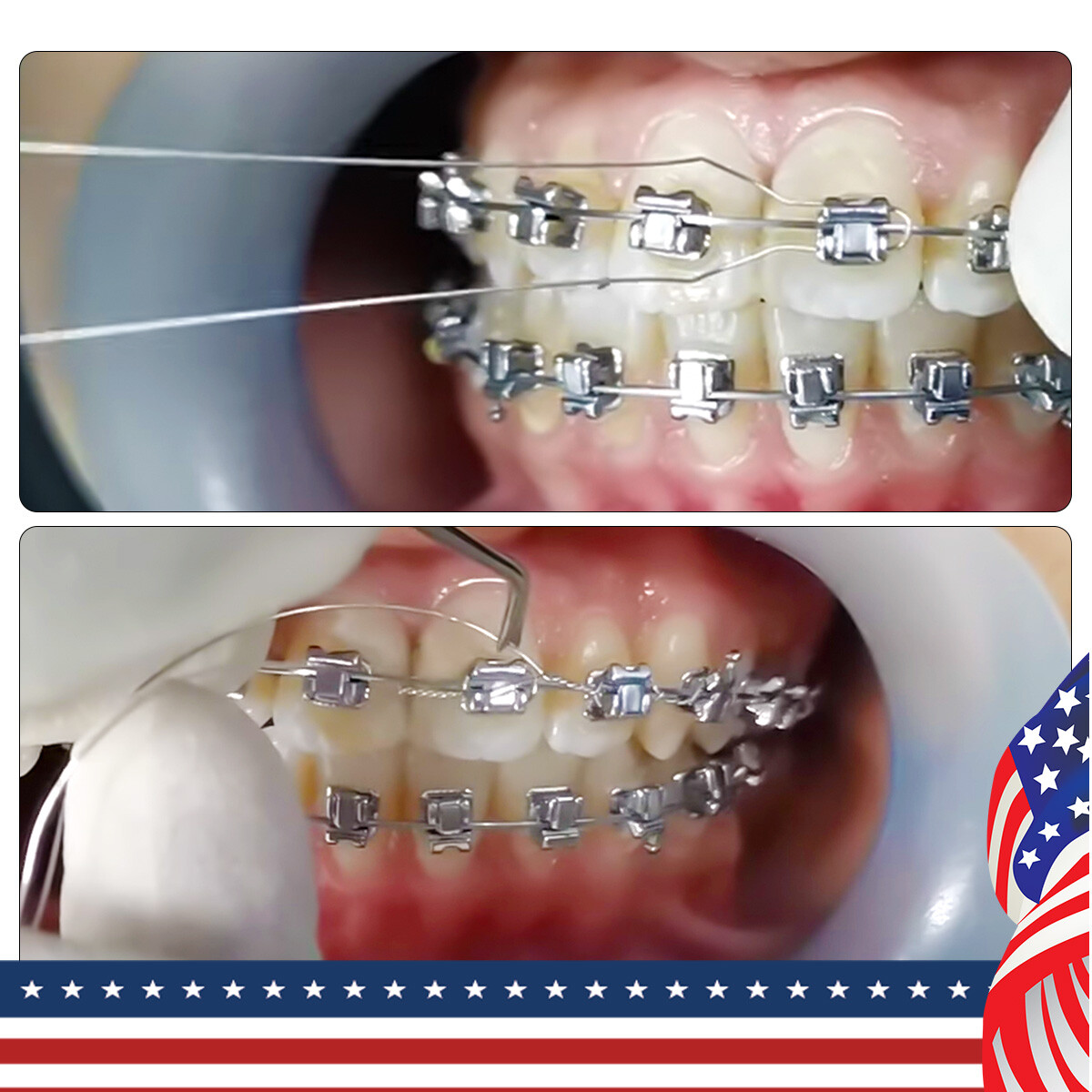 Dental Orthodontic Wire Preformed Kobayashi Ligature Tie Medical Stainless Steel