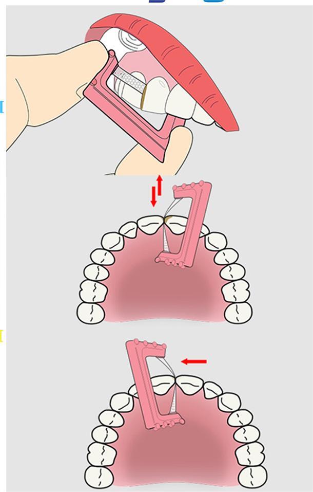 IPR Stripping Plus System Kits Orthodontic Autoclavable&Reusable Assorted 100pcs