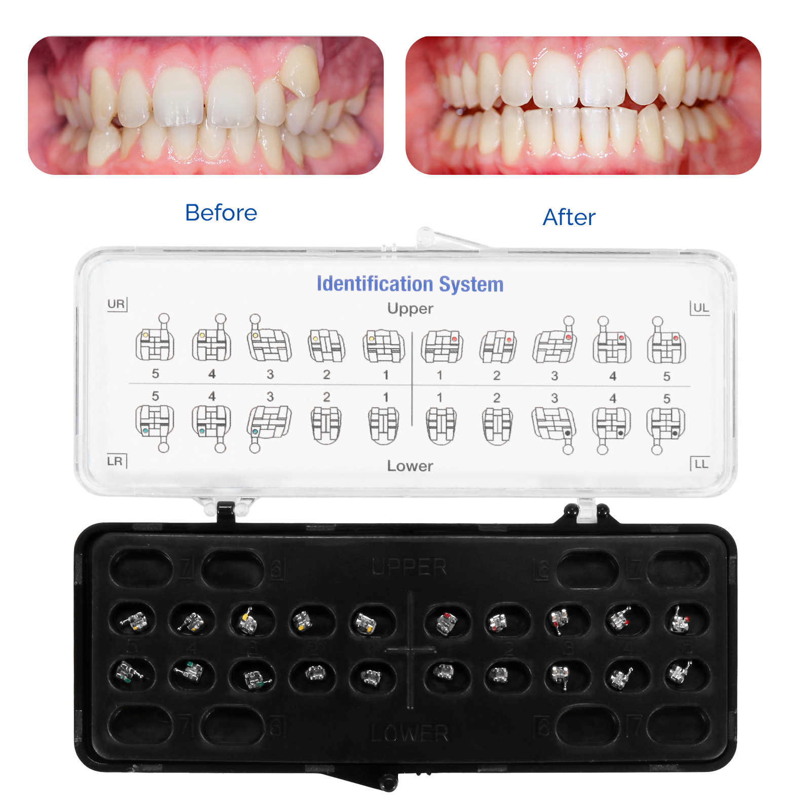 10X JMU Ortho Metal Brackets Brace Mini & Standard Roth/MBT 022/018 Hooks 3-4-5