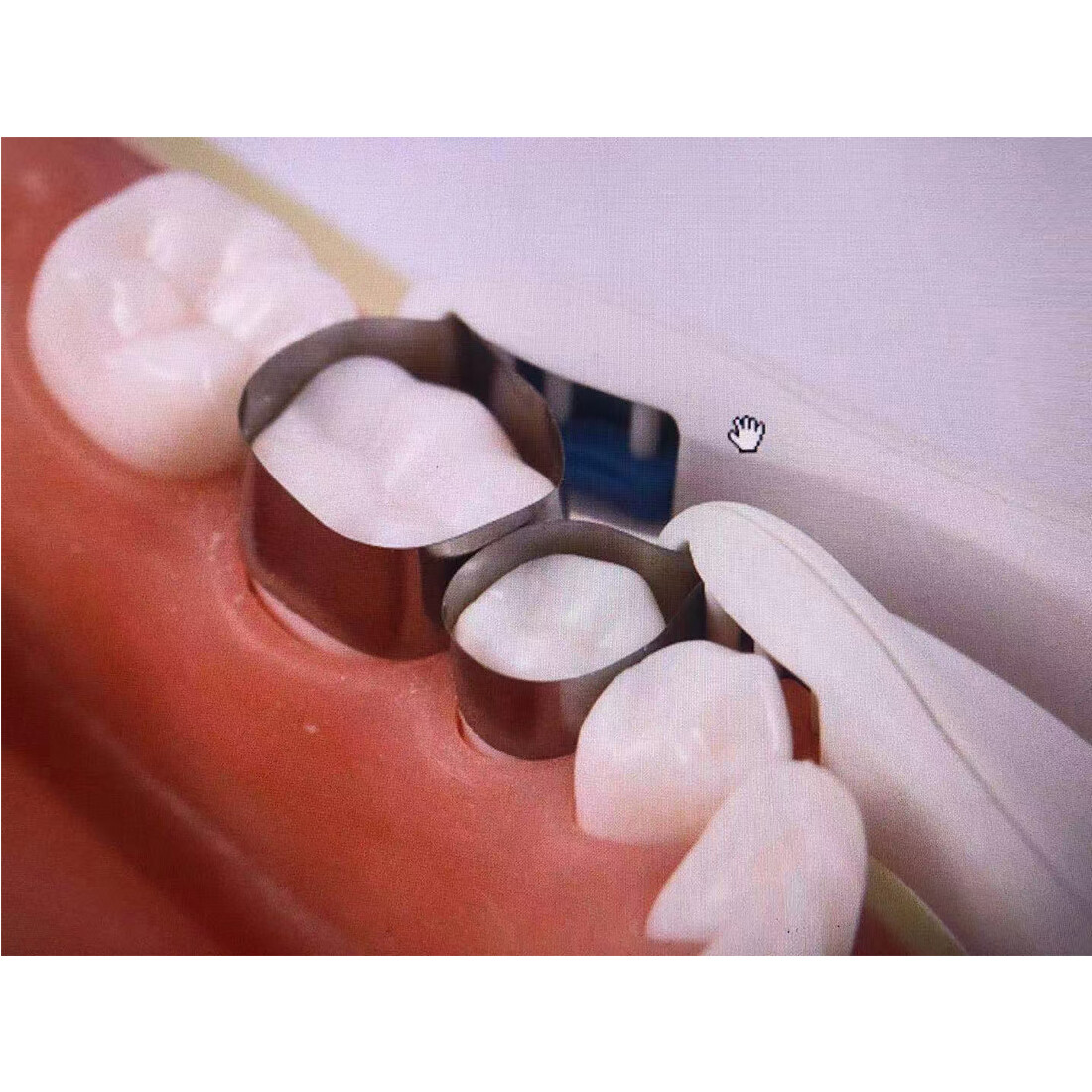 10Pcs Dental Pro Matrix Band Sectional Contoured Ring Matrices System Restoratio