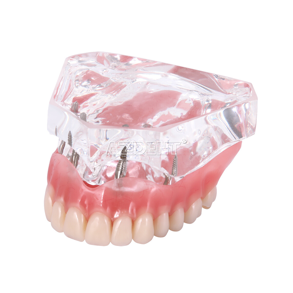 Modelo Demostración Implantes Dentales Sobredentadura Rehabilitada Sup/Inf 2 y 4