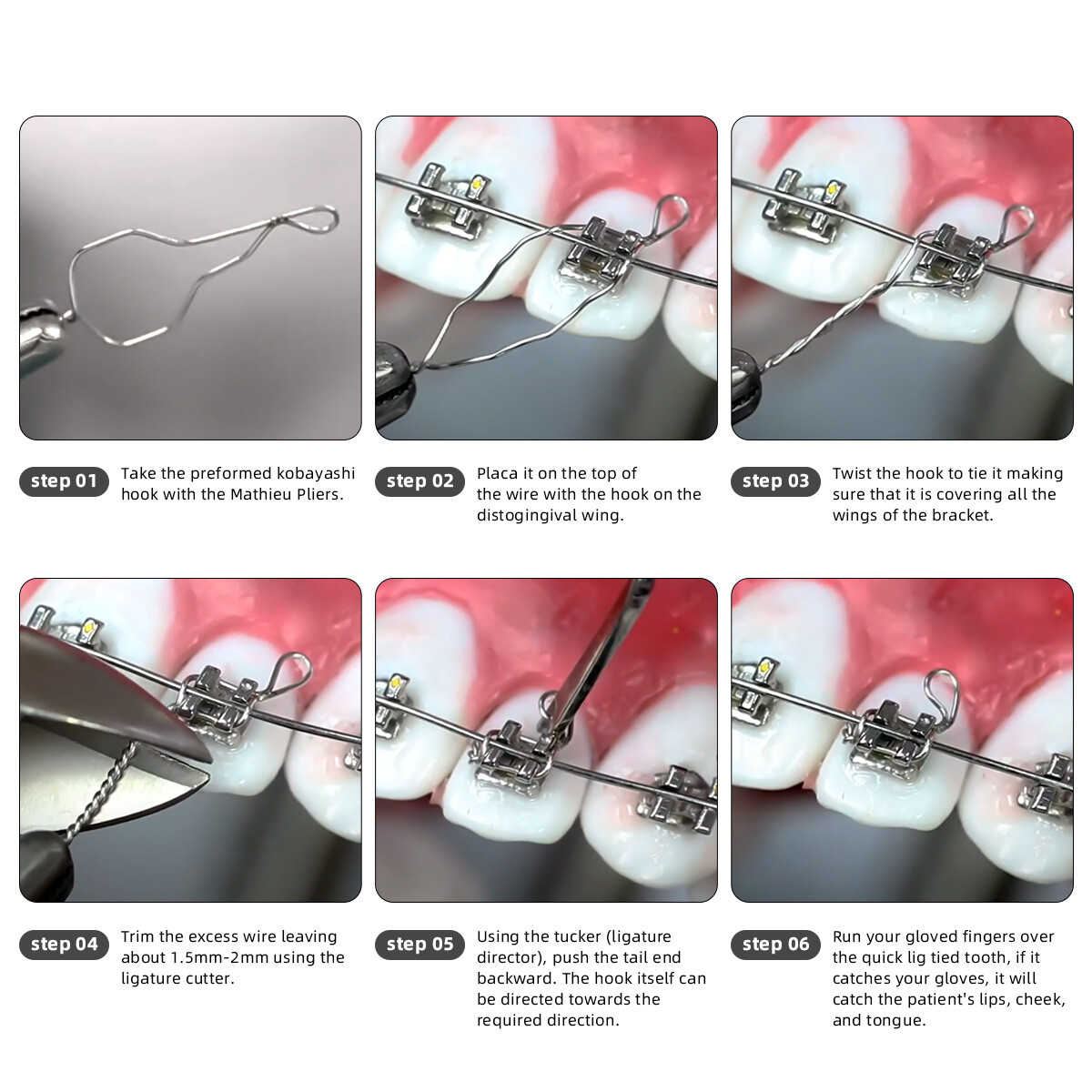 Alambre de ortodoncia oral prefabricado atadura de alambre de conexión Kobayashi