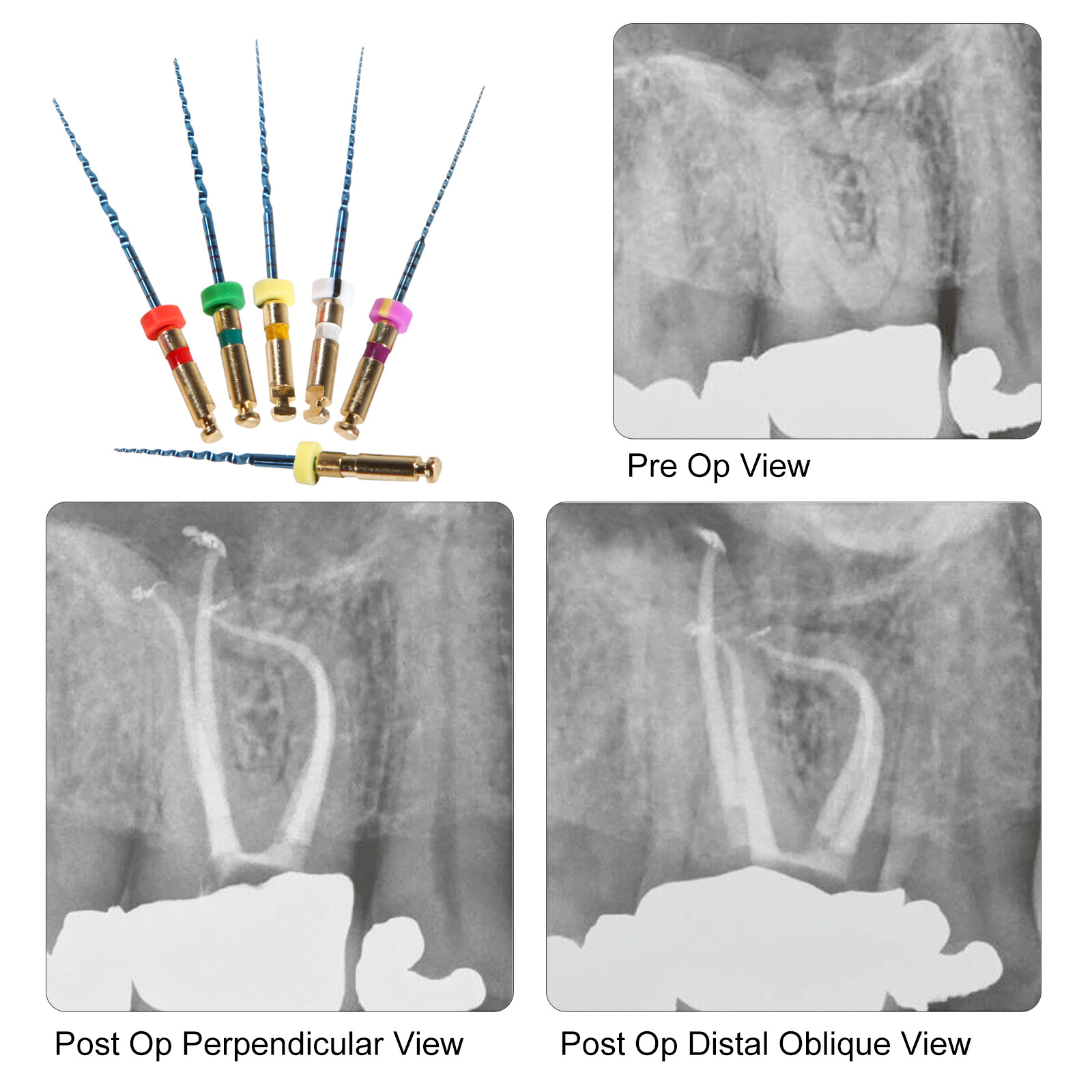 LED Dental Endo Motor 16:1 Contra Angle Root Canal Treatment Y-smart /NITI Files