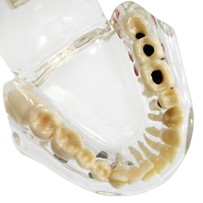 Dental Implant and Restoration Model Transparent Pathological Teeth Study Model