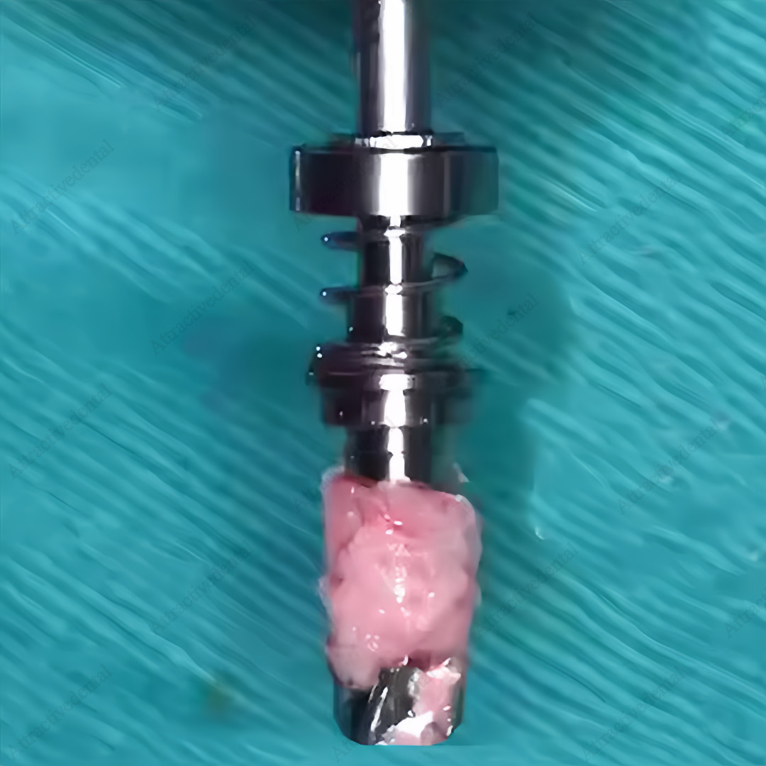 ⌀5.0mm Dental Autograft Drills Implant Spring Bone Harvest Drill Collector