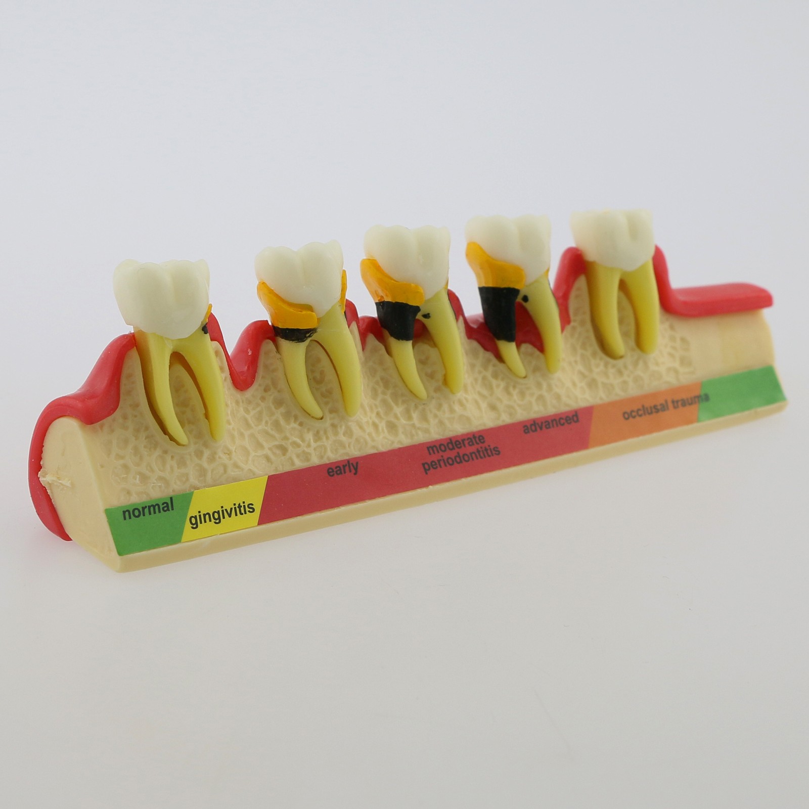 US Dental Teeth Model Periodontal Disease Assort Model 4 5-Stage Endodontic Demo