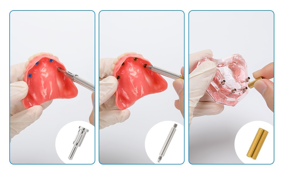US Locator Abutment Zimmer Screw-Vent 3.5mm Overdenture Cap Implant Abutment