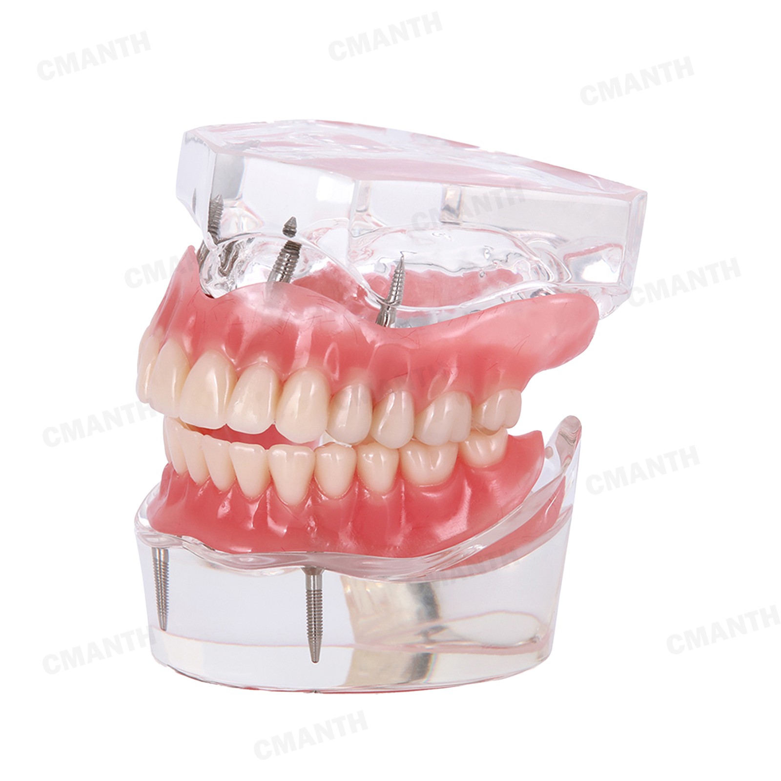 US Dental Model Removable Overdenture Teeth Upper/Lower Jaw 4 Implants Model