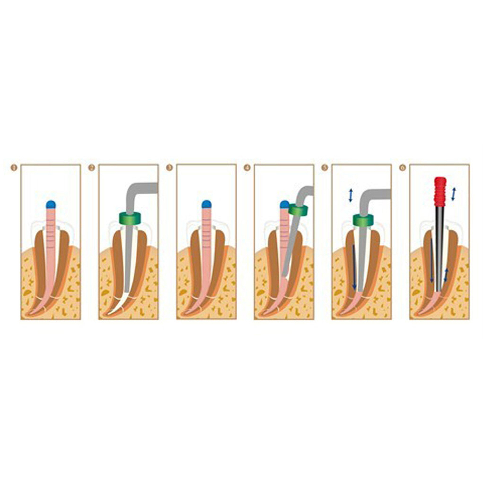 ORIGINAL Sybron Endo Buchanan System B Heat Plugger Elements Obturation Tip