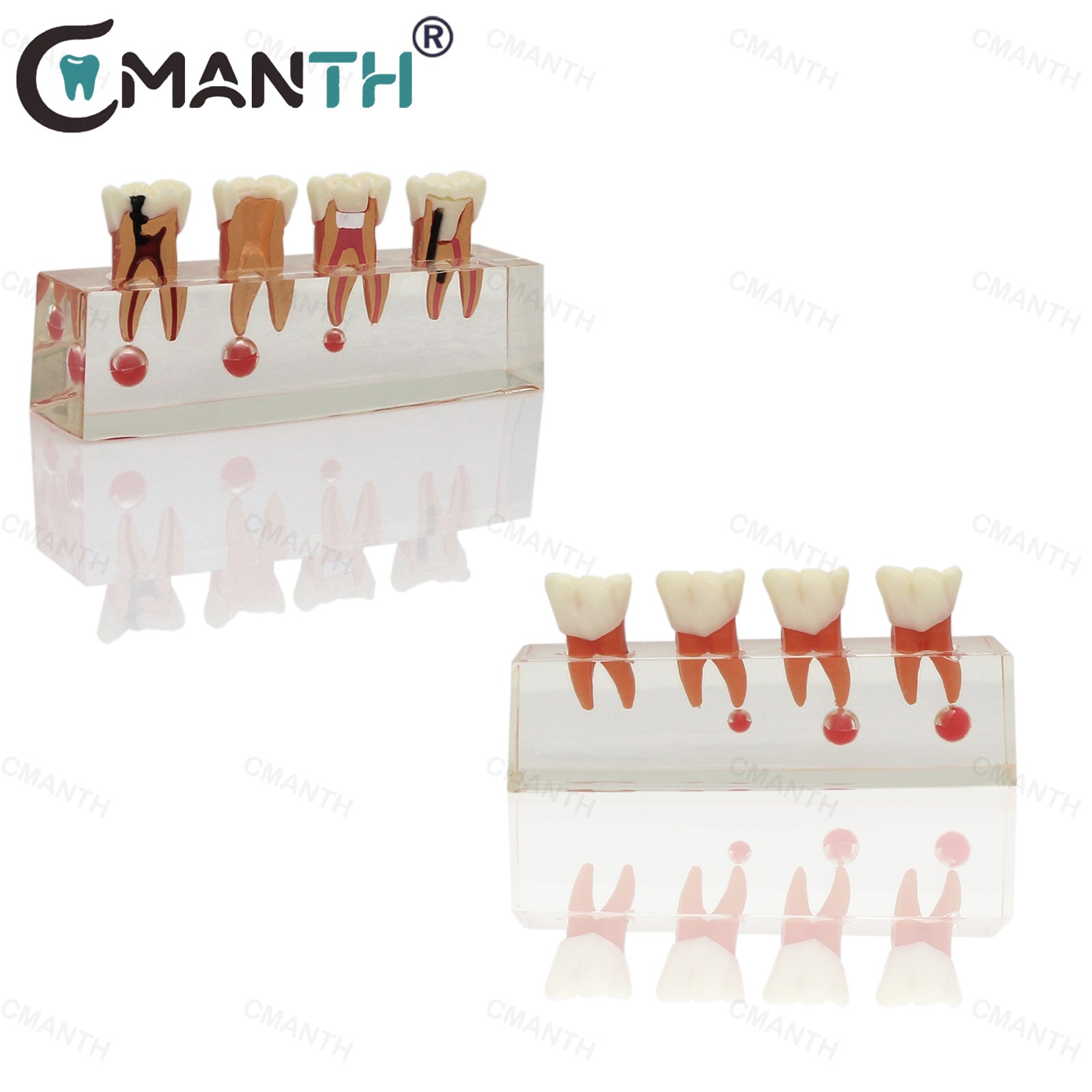 US Dental Teeth Model Periodontal Disease Assort Model 4 5-Stage Endodontic Demo