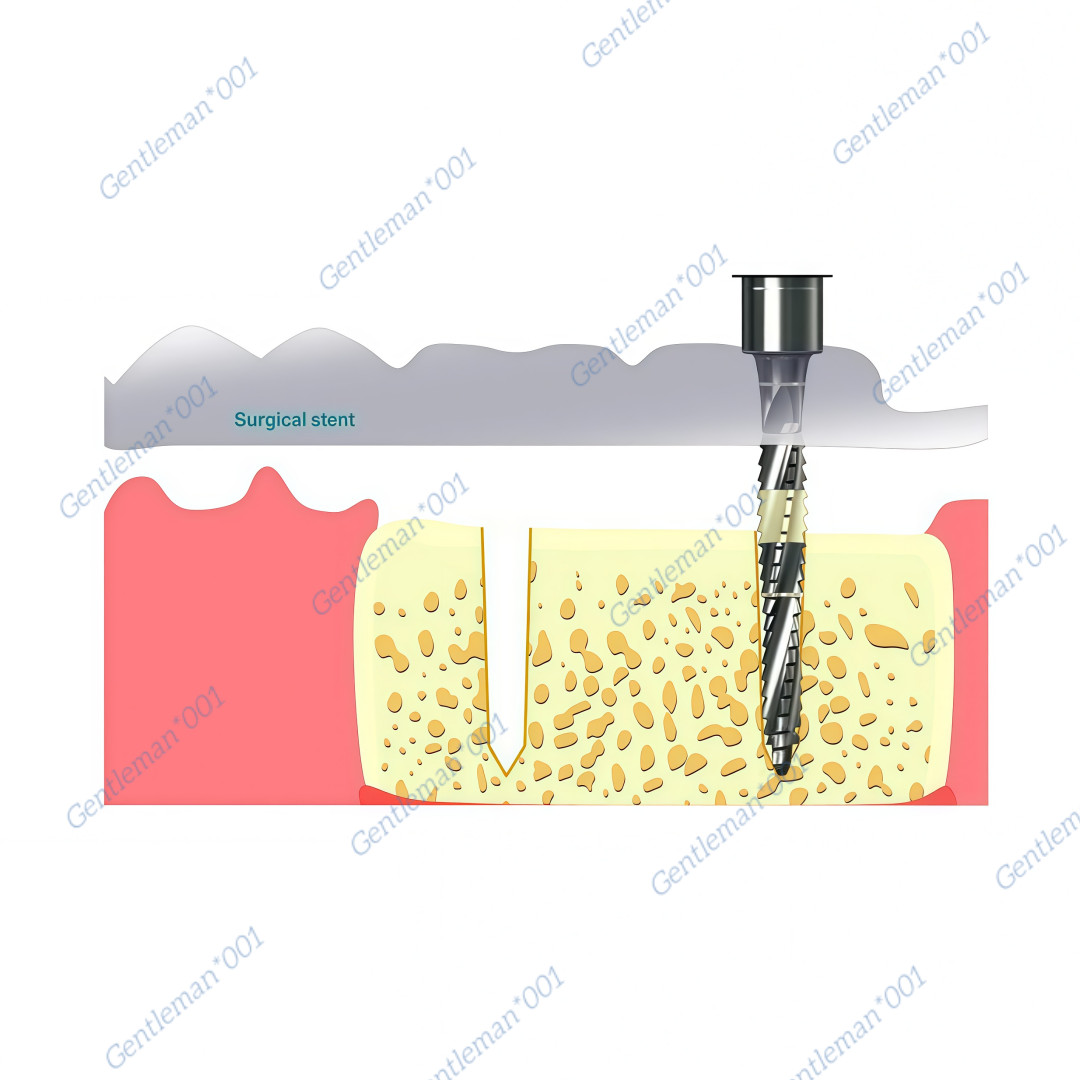 Dental Implan Cross Cutter Drill Cut Debris Blade Fit Lindemann Point Head