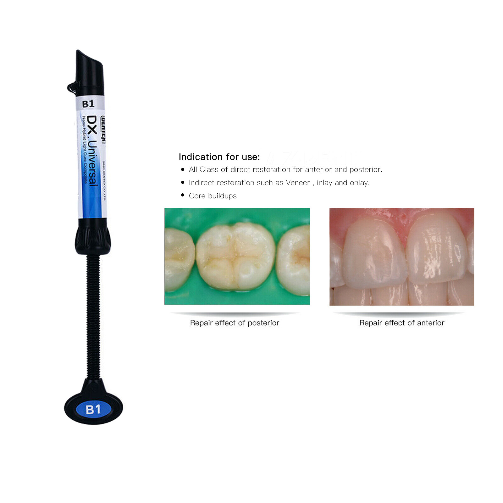 DX Dental Universal Light Cure Composite Resin A1,A2,A3,A3.5,B1 Shade 4g/Syringe