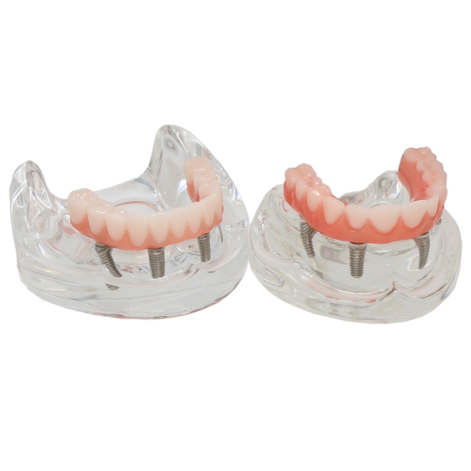 All-On-4 Dental Implant System Overdenture Treatment Teeth Model U/L Jaw W/screw