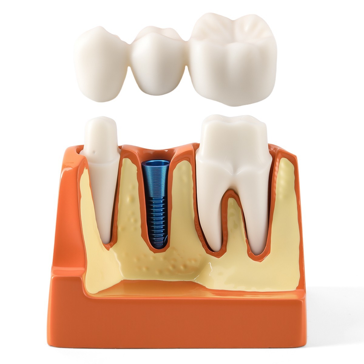 Dental 4 Times Teeth Model Implant Analysis Crown Bridge Demonstration Removable