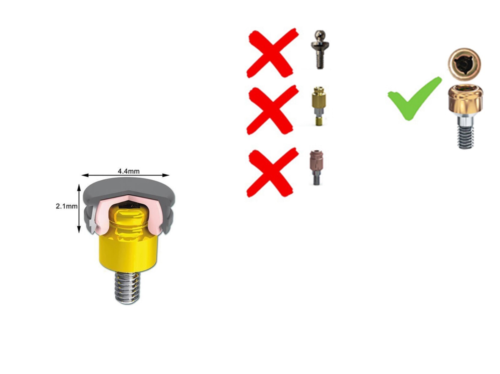 US Overdenture Locator Abutment Removable Male Cap Inserts Standard/Extended Set