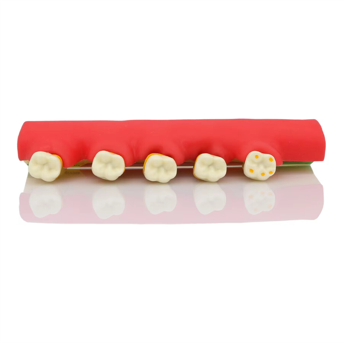 Dental Pathological Typodont Teeth Model Periodontics/Implant/Endodontic Caries