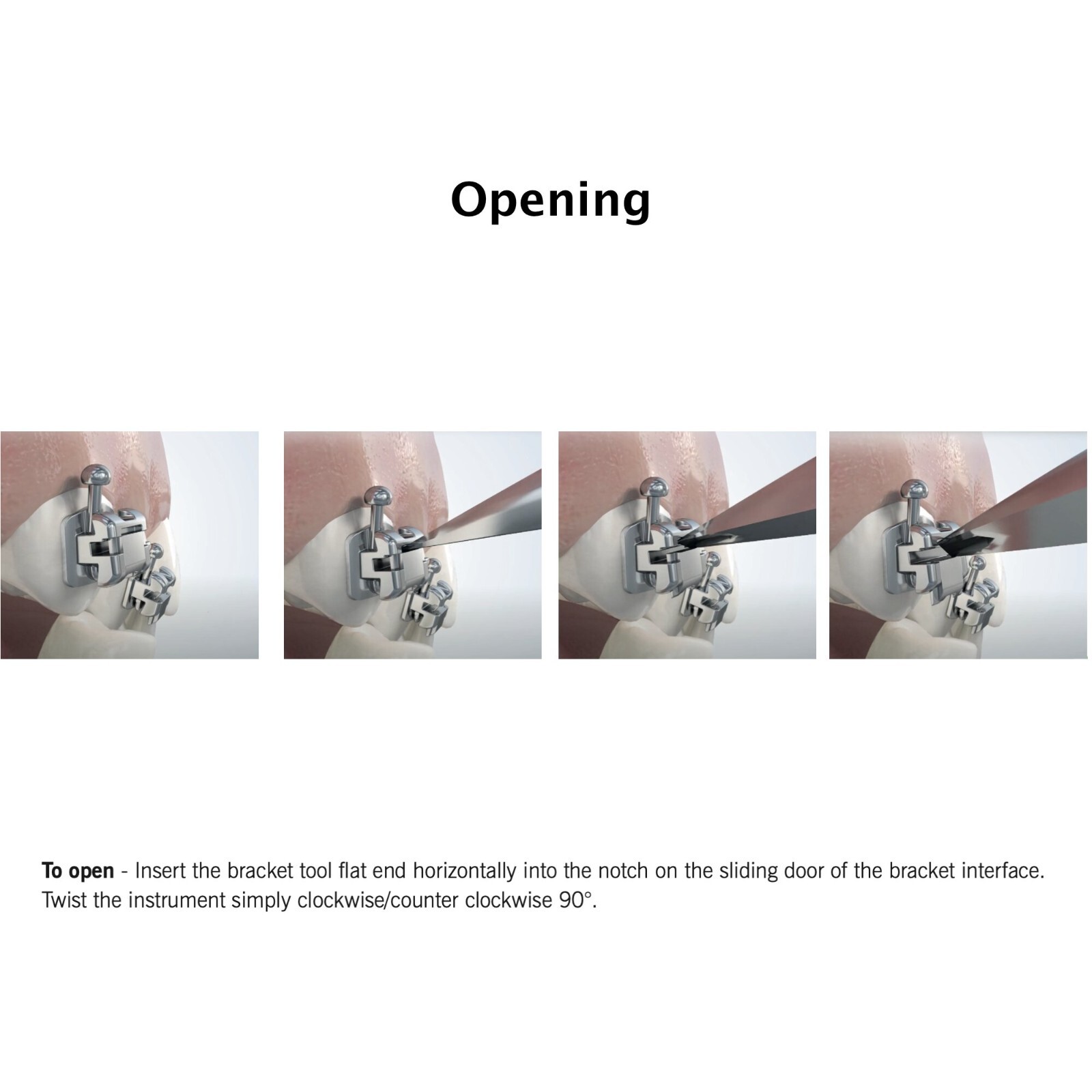 Dental Orthodontic Brackets Self Ligating Braces Metal Ceramic Roth MBT 022 345
