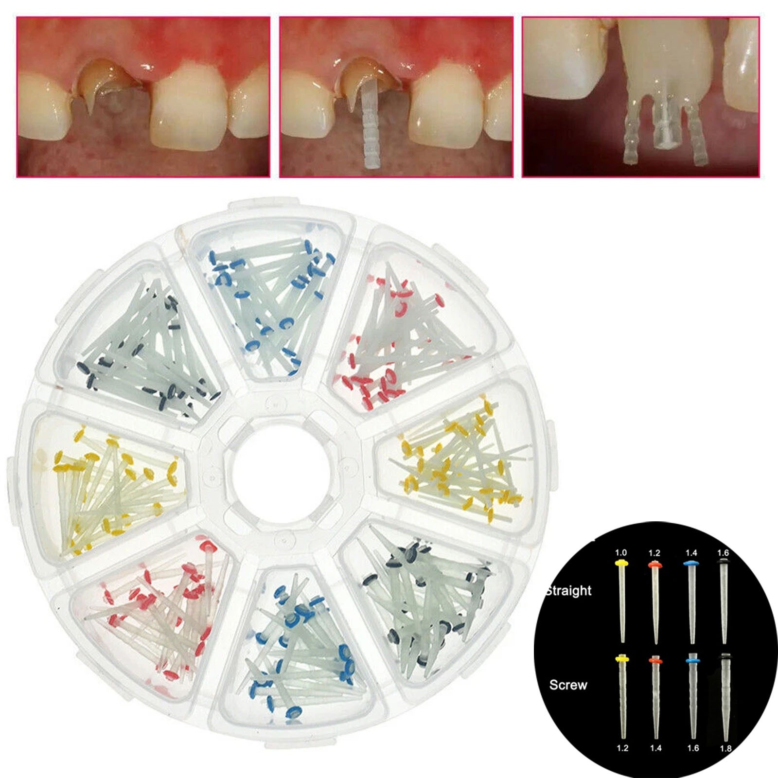 200Pcs Dental Fiber Post Glass Quartz Teeth Restorative 1.0/1.2/1.4/1.6/1.8mm