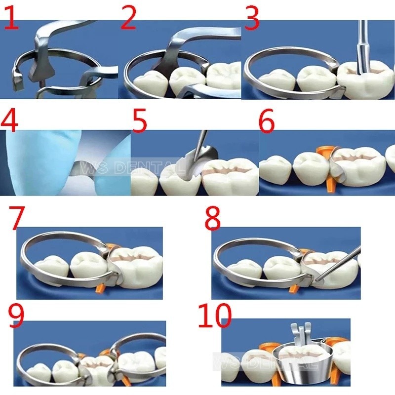 10 Set TOR VM Dental Matrix Bands Sectional Contoured Matrices Wedges Ring Clamp
