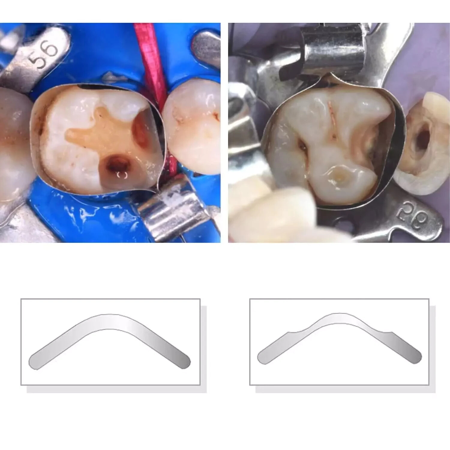 20Pcs/Bag Dental Tofflemire Matrix Bands 0.04mm Margin Elevation/Large Curvature