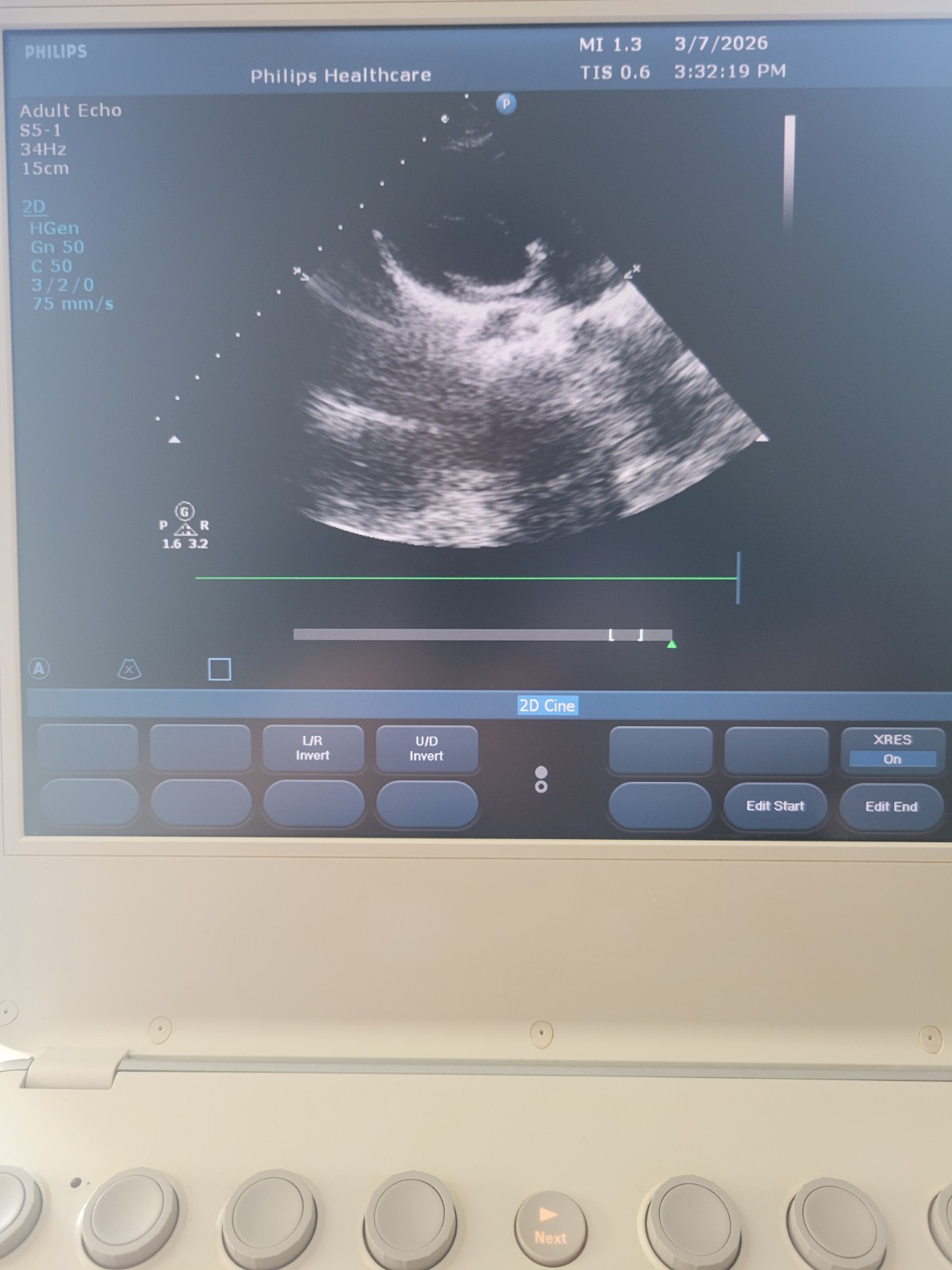 Philips CX50 Ultrasound System w/ Cart S5-1 & L12-3 Probes + Sony Printer Echo