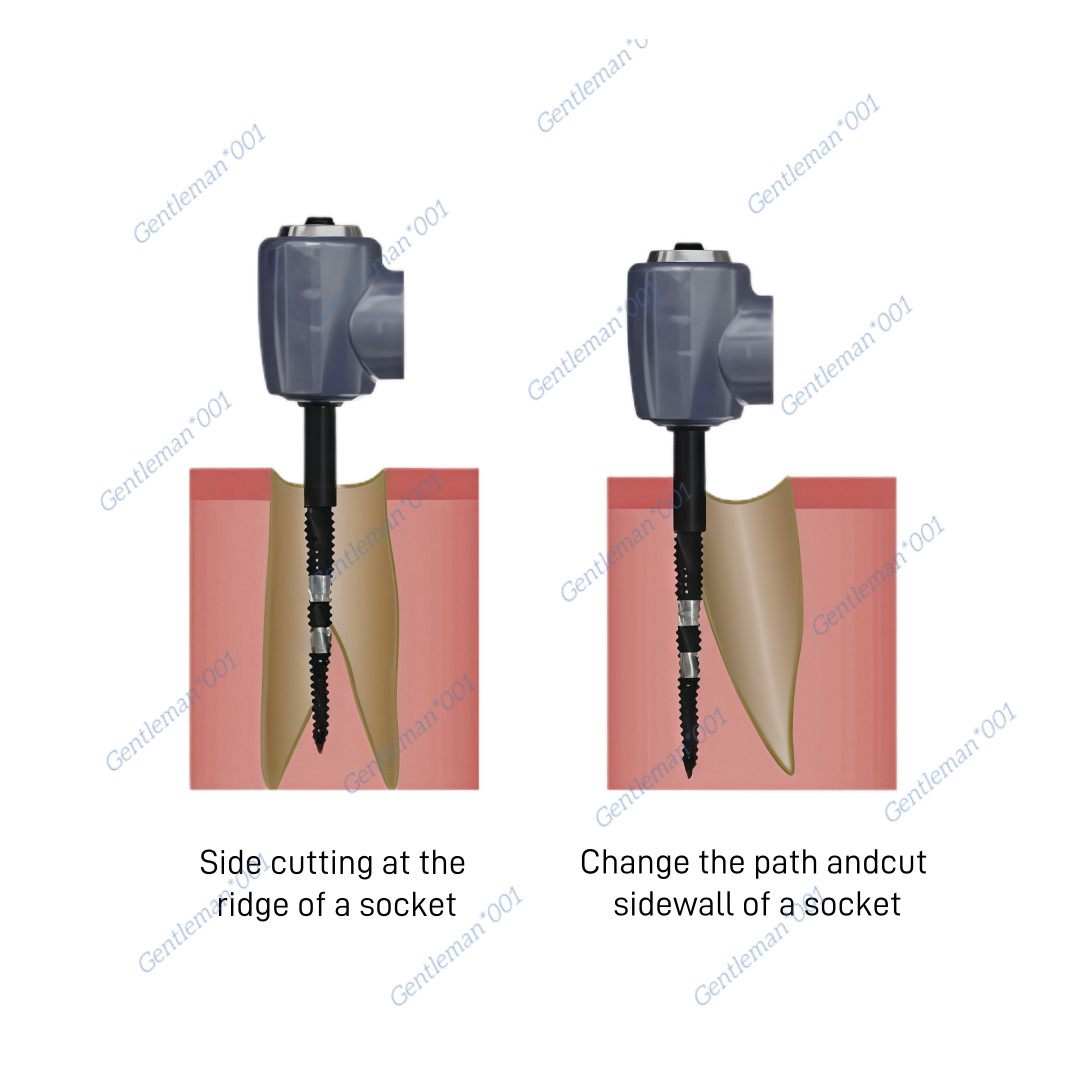 Dental Implan Cross Cutter Drill Cut Debris Blade Fit Lindemann Point Head