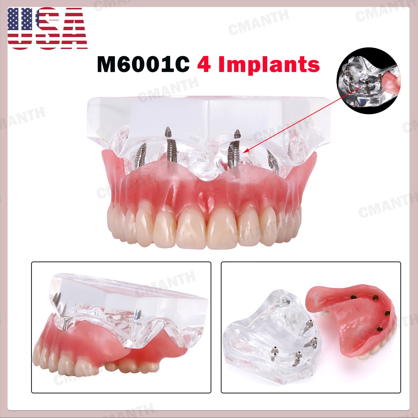 US Dental Model Removable Overdenture Teeth Upper/Lower Jaw 4 Implants Model