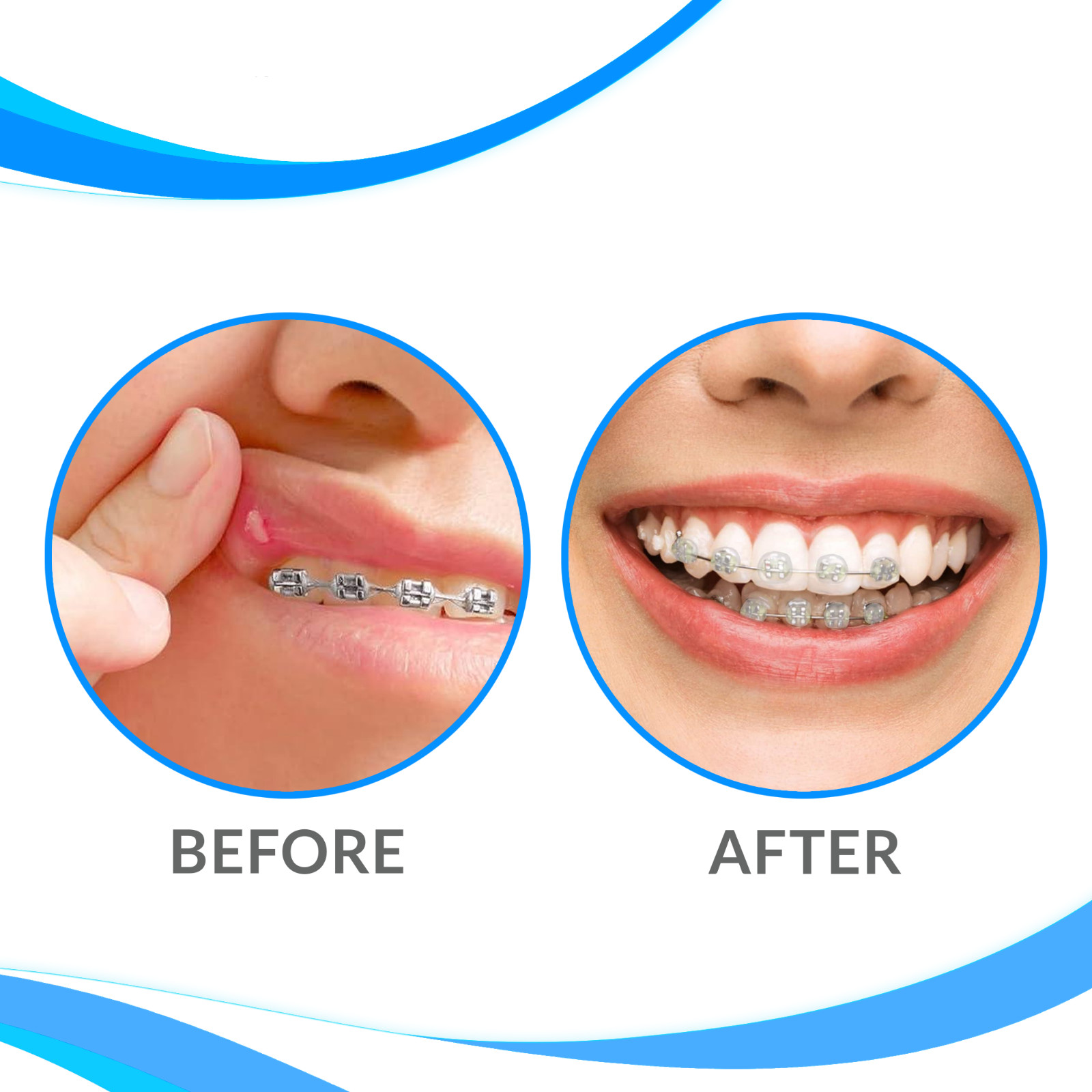 Dental Orthodontc Wax White-Original/Mint Scent For Bracket Brace Gum Irritation