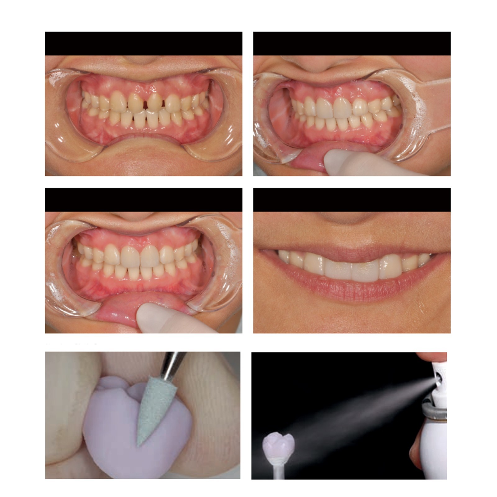 US Dental Emax Ceramic Lithium Disilicate Blocks C14 CAD/CAM CEREC Inlab Blocks
