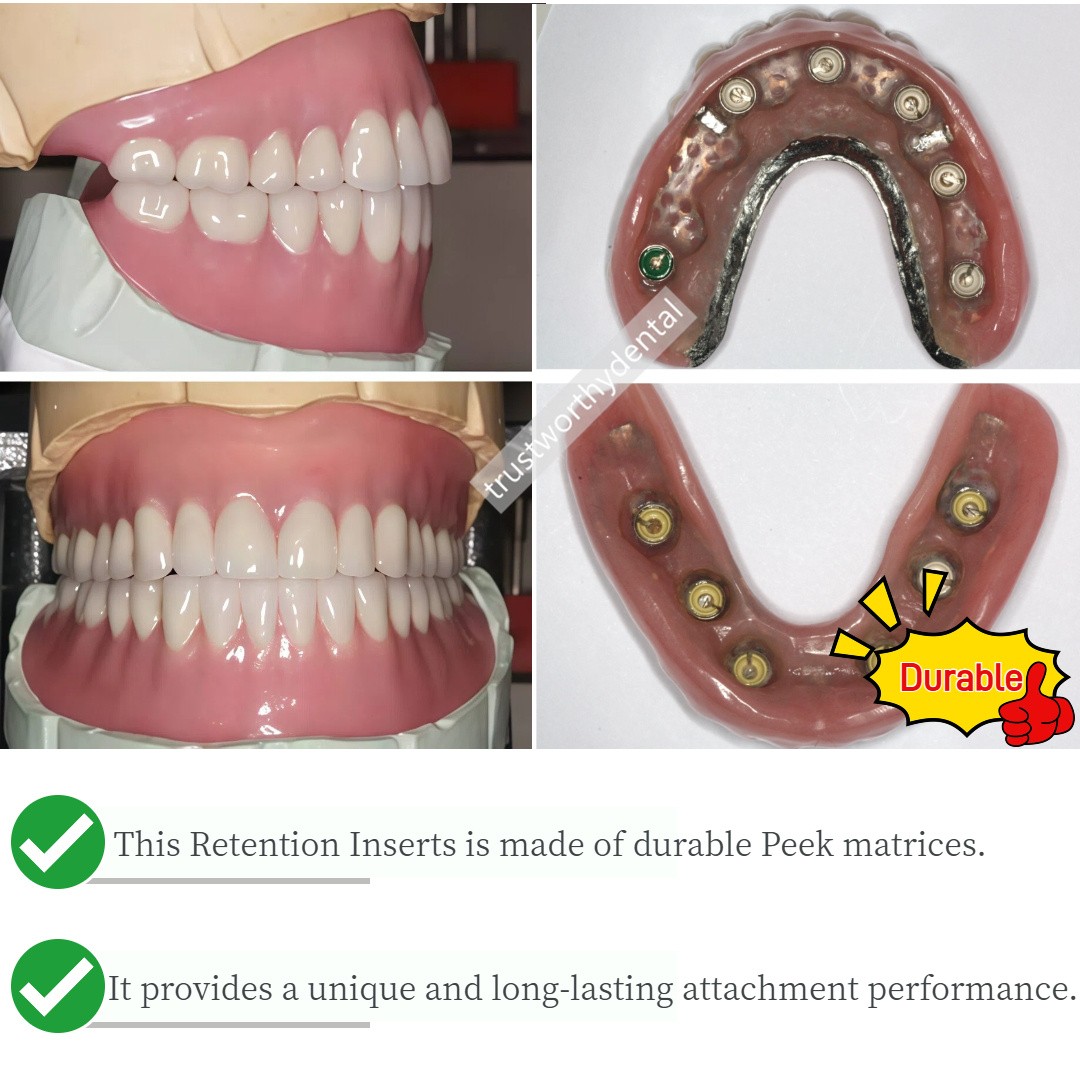 Dental Novaloc Retention Inserts Caps Kit Peek Inserts Titanium Matrix Housing