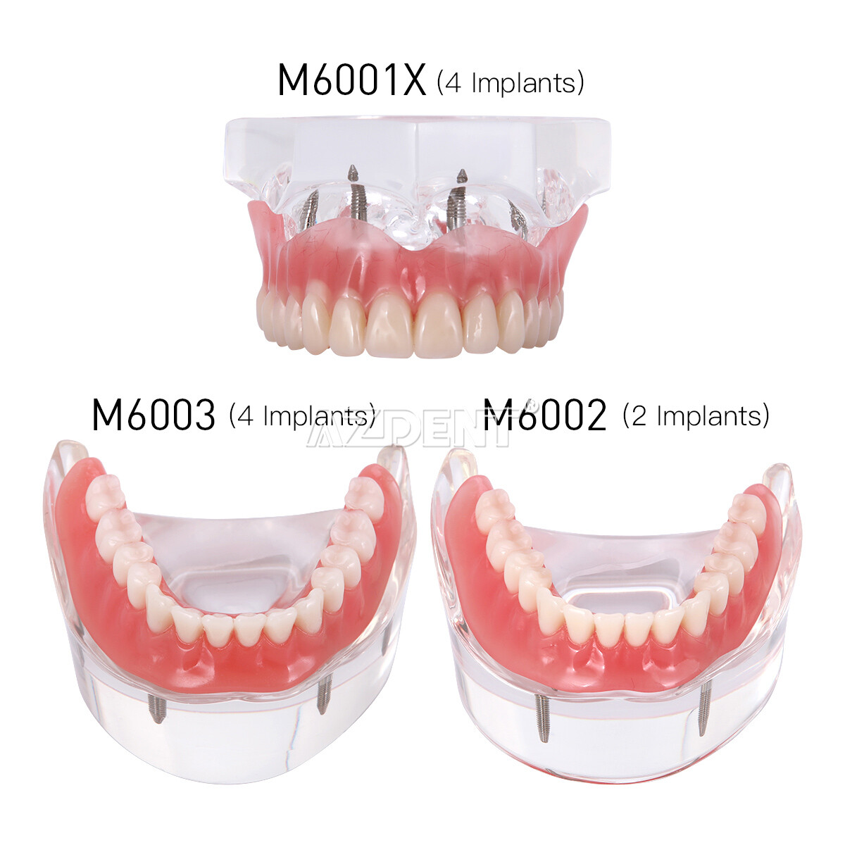 Dental Implant Teeth Model Demo Overdenture Restoration 2 / 4 Implants Upper Low
