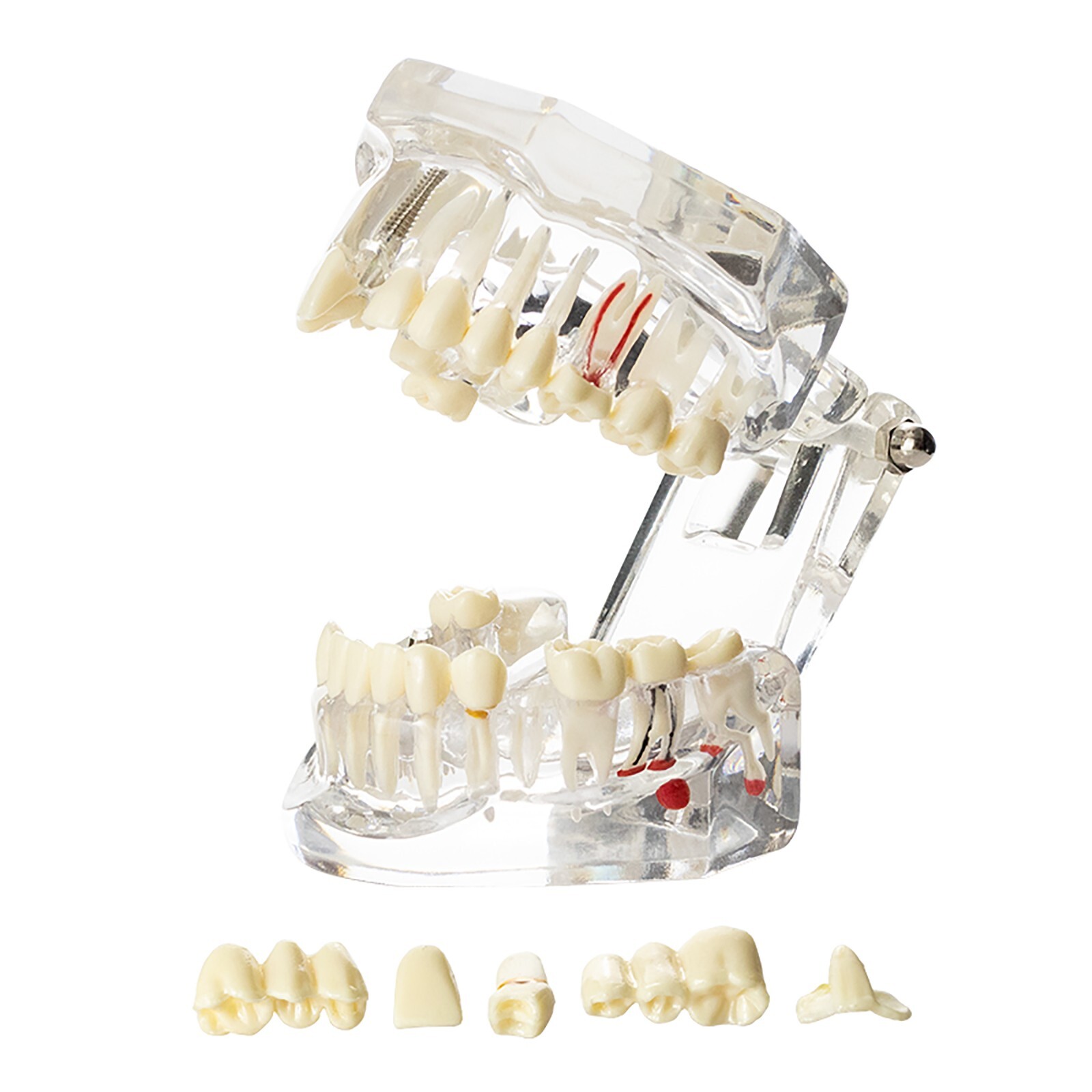 Dental Typodont Teeth Model Implant Pathological Perio Restoration Practice Demo