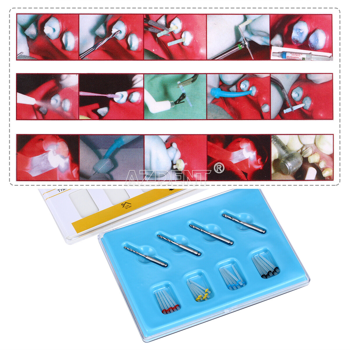Dental Glass Fiber Post Teeth Restorative Refill Screw Posts 1.2 1.4 1.6 1.8mm