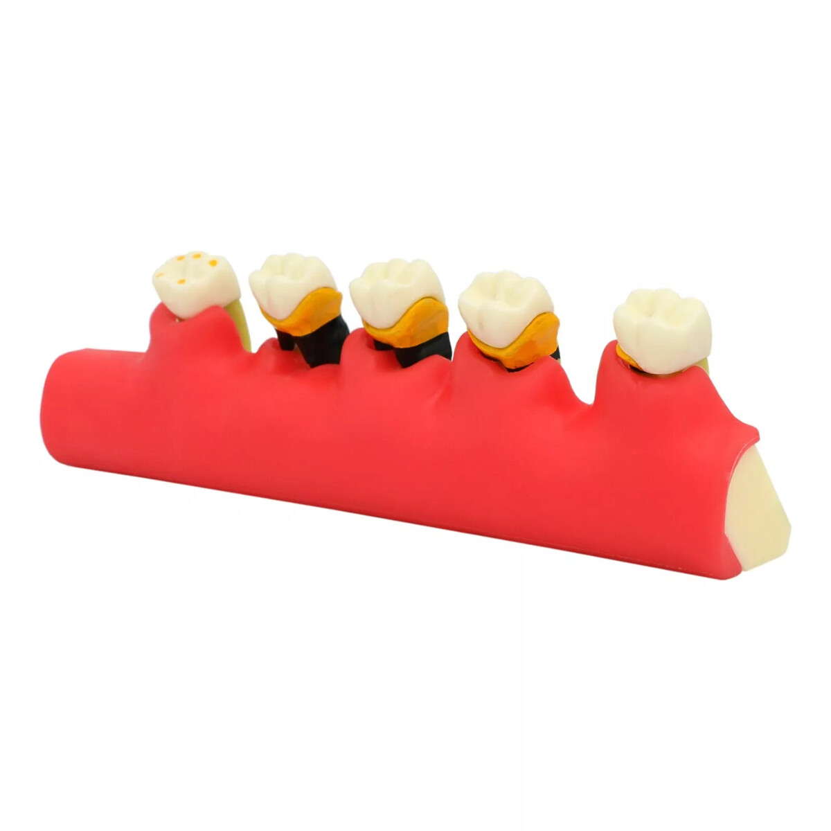 Dental Pathological Typodont Teeth Model Periodontics/Implant/Endodontic Caries