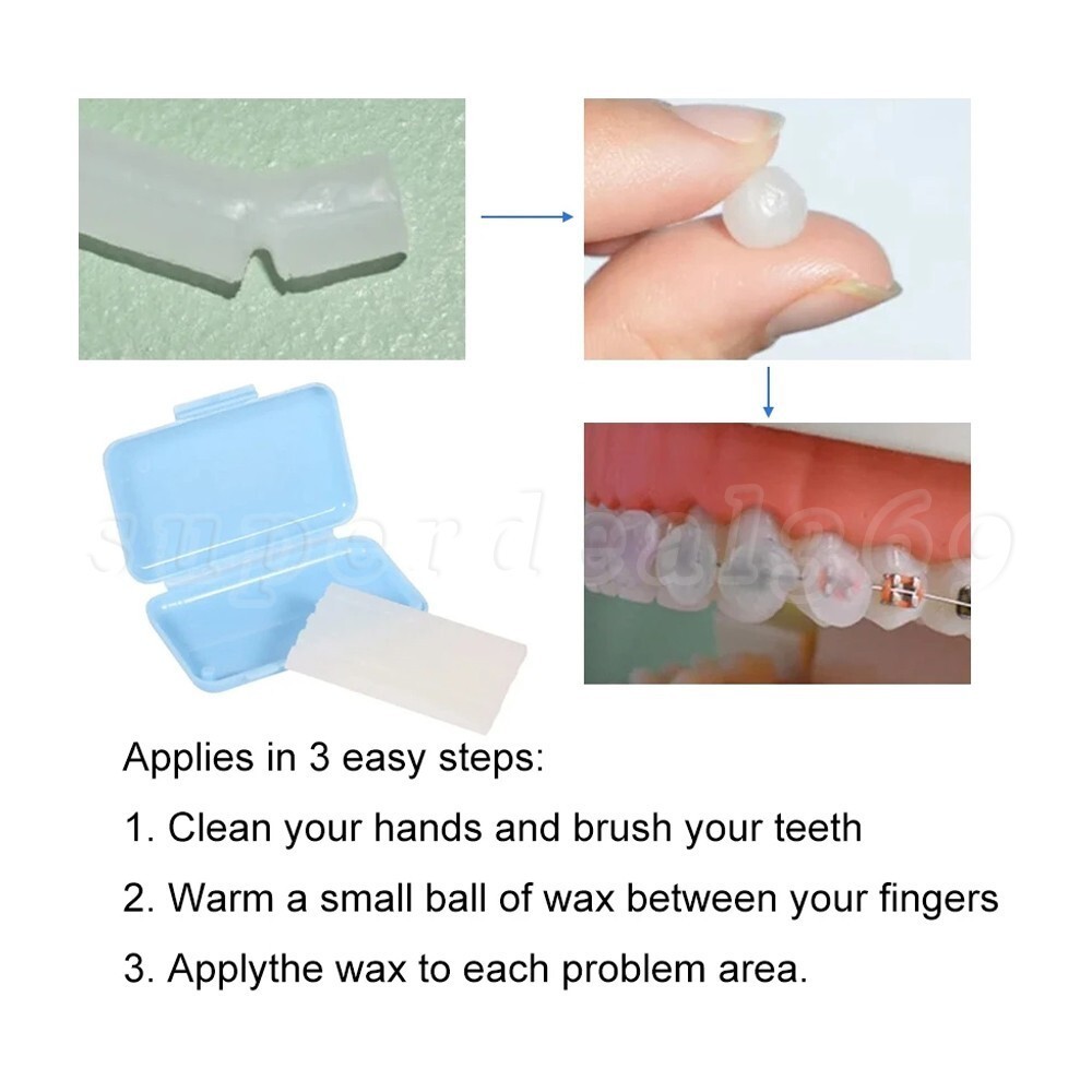 10 Packs Dental Orthodontic Wax for Relief Braces Gum Irritation Mint Scent su
