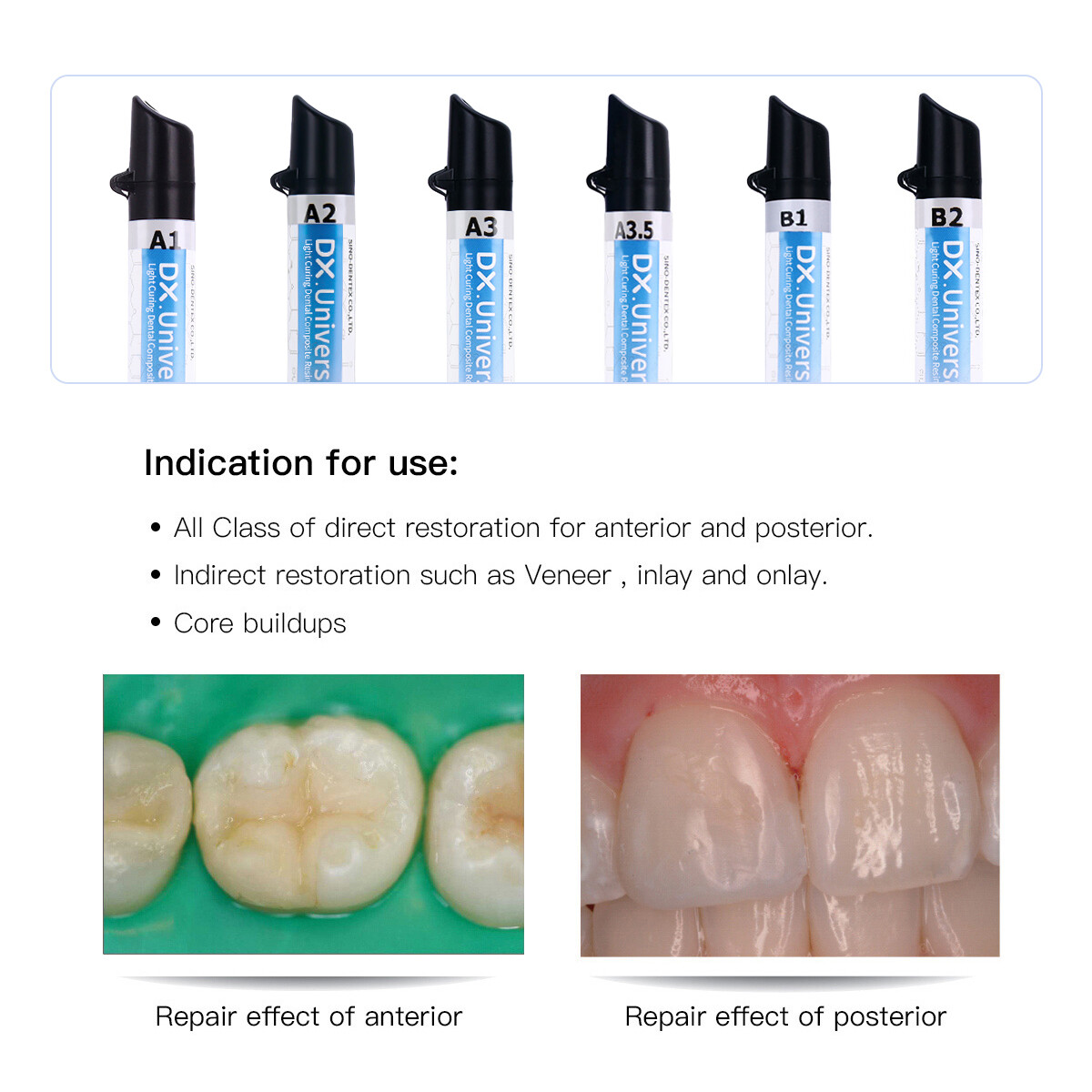 Dentex Dental Curing Light Type Composite Resin Shade A1 A2 A3 A3.5 B1