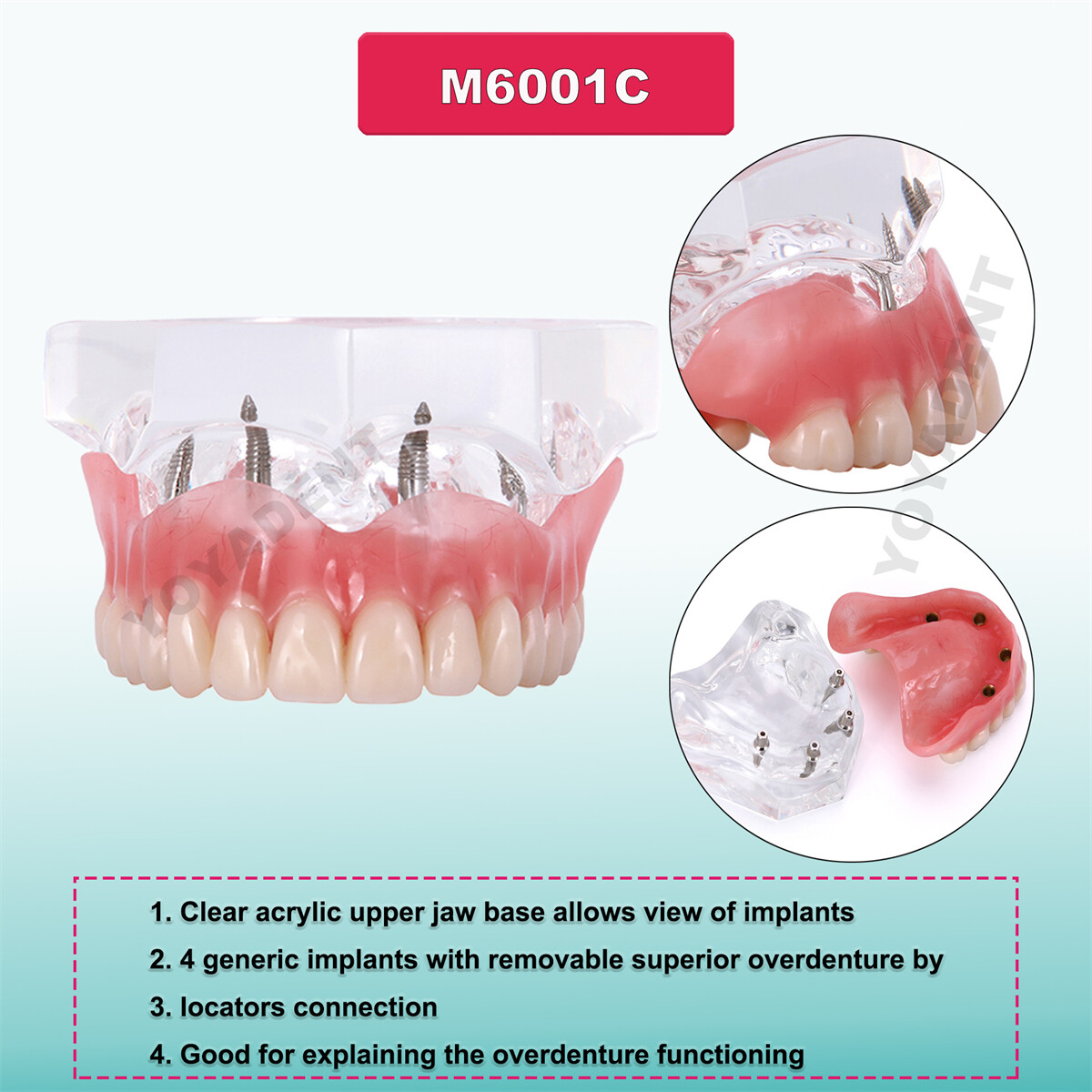 US Dental Teeth Model Overdenture Inferior Implants Demo Upper/Lower Detachable